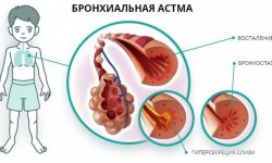 Корінь імбиру при бронхіальній астмі: цілющі властивості, рецепти народної медицини