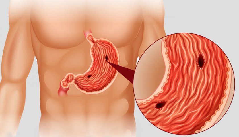Виразкові рубці в шлунку