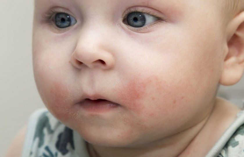 Алергія у немовляти