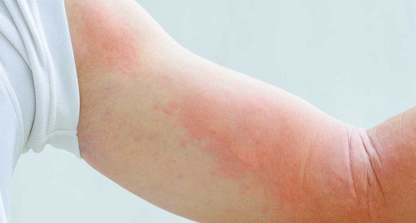 Алергічна реакція на імбир