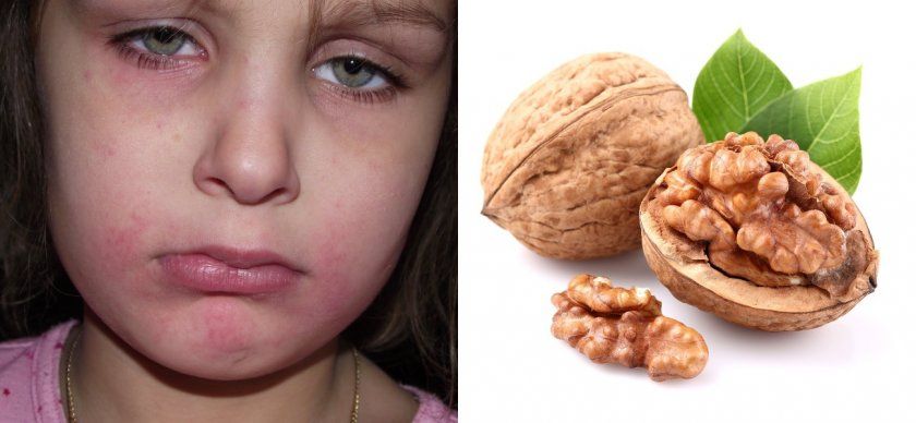 Алергія на волоські горіхи у дитини