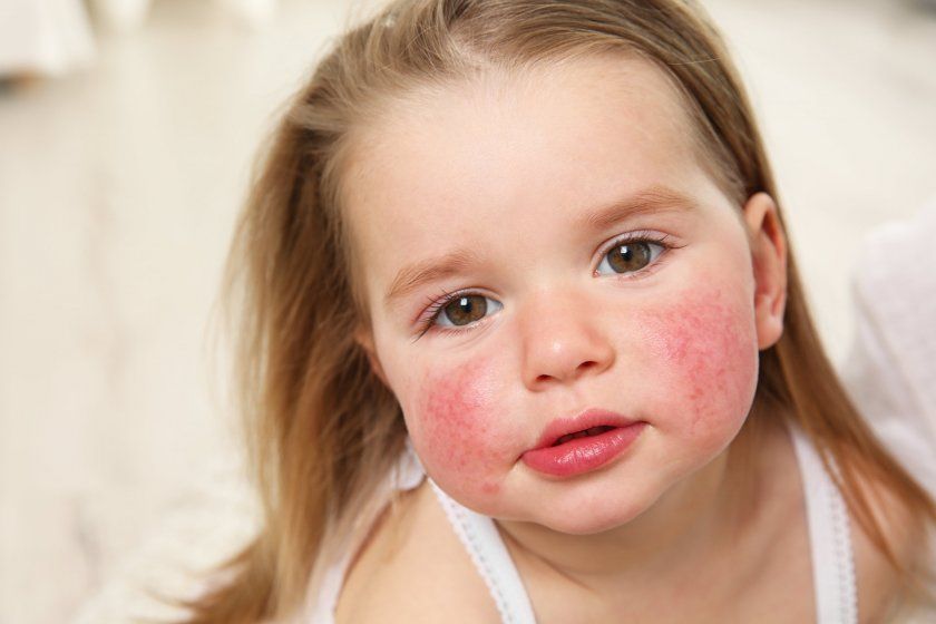 Алергія на волоські горіхи у дітей