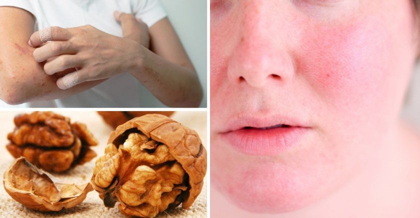 Алергія на волоські горіхи у дорослих