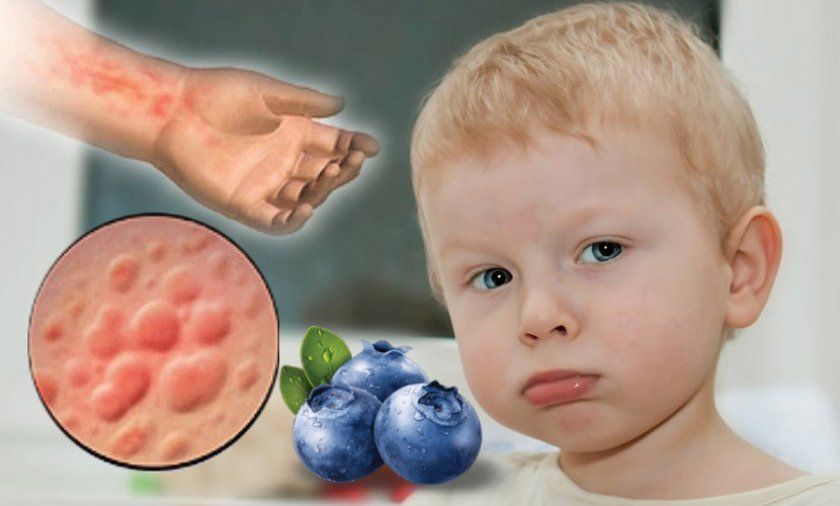 Алергія на чорницю у дітей