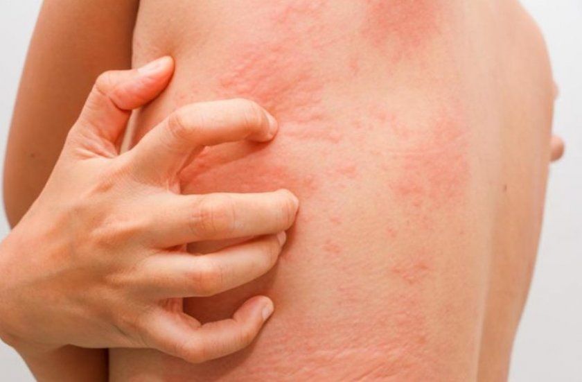 Симптоми алергії у дітей