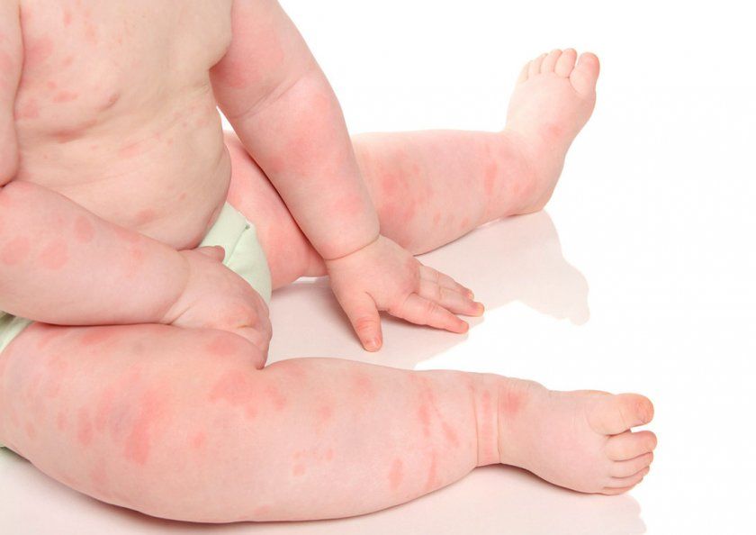 Алергічна реакція у дитини на смородину