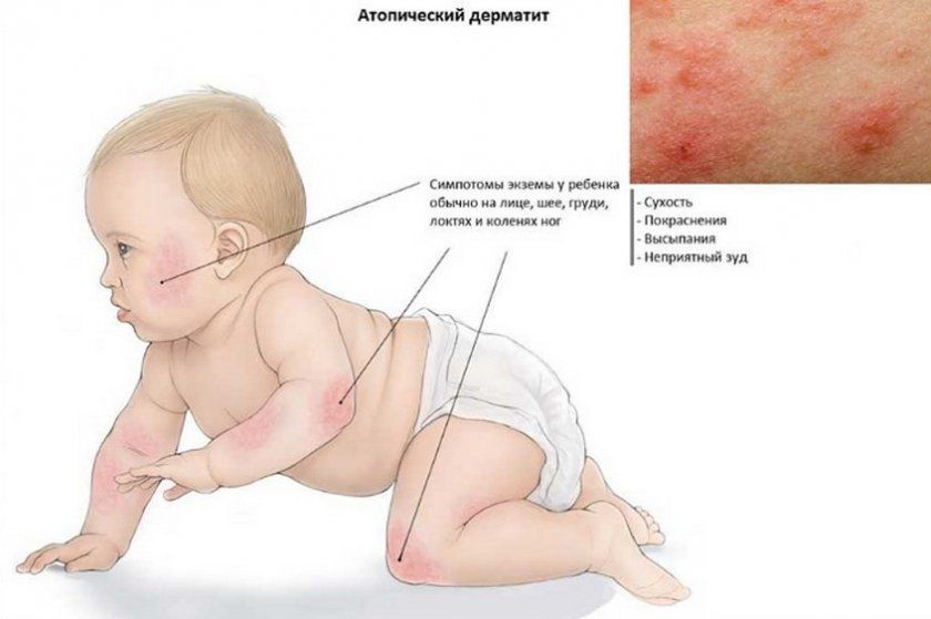 Атопічний дерматит у дитини