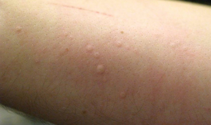 Алергія на горіх у дітей