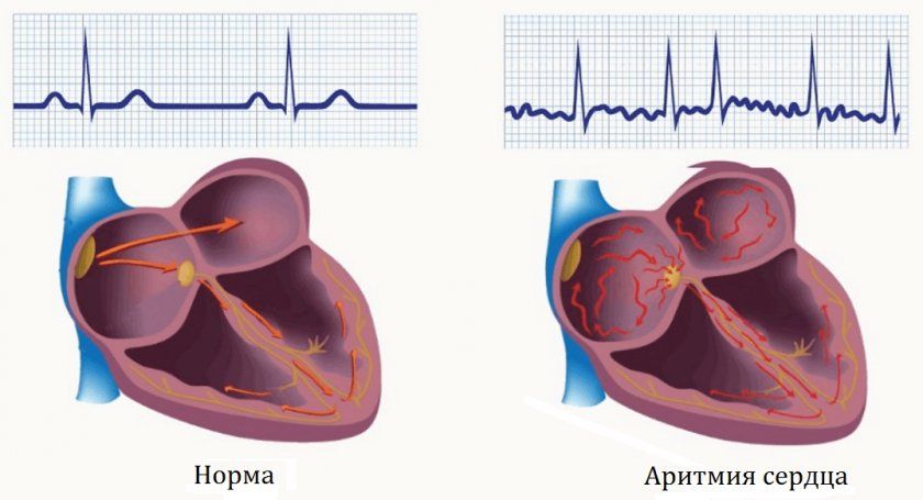 аритмія серця