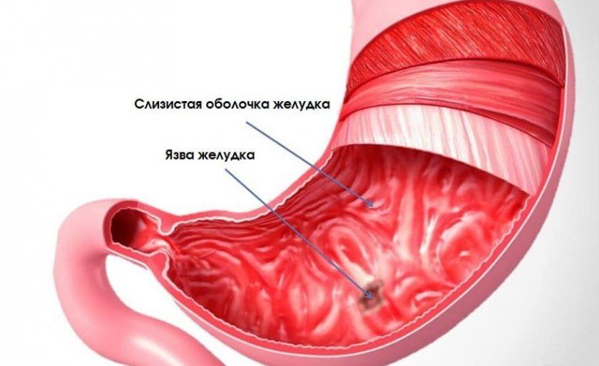 Виразка шлунку