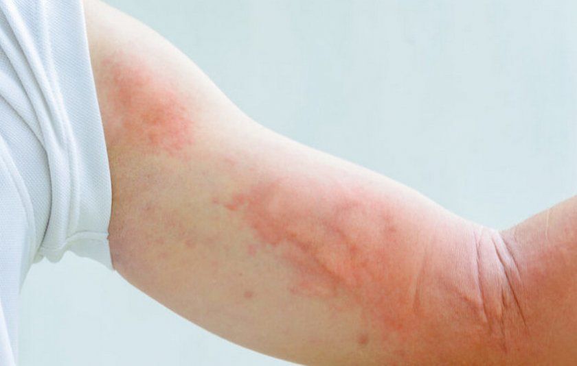 Алергія на імбир